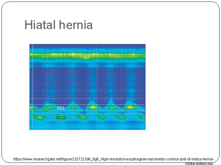 Hiatal hernia https: //www. researchgate. net/figure/232722390_fig 8_High-resolution-esophageal-manometry-contour-plot-of-hiatus-hernia. White-dotted-box 