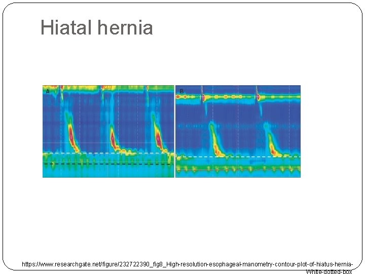 Hiatal hernia https: //www. researchgate. net/figure/232722390_fig 8_High-resolution-esophageal-manometry-contour-plot-of-hiatus-hernia. White-dotted-box 