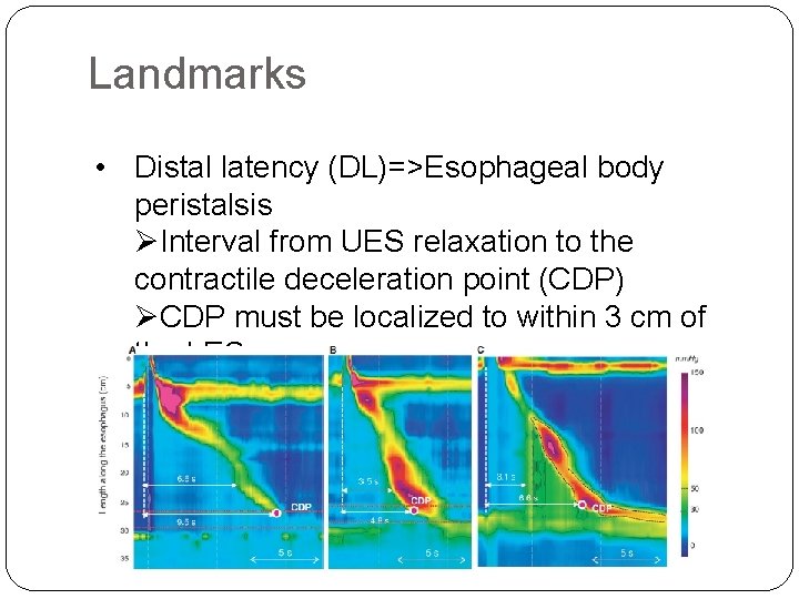 Landmarks • Distal latency (DL)=>Esophageal body peristalsis ØInterval from UES relaxation to the contractile