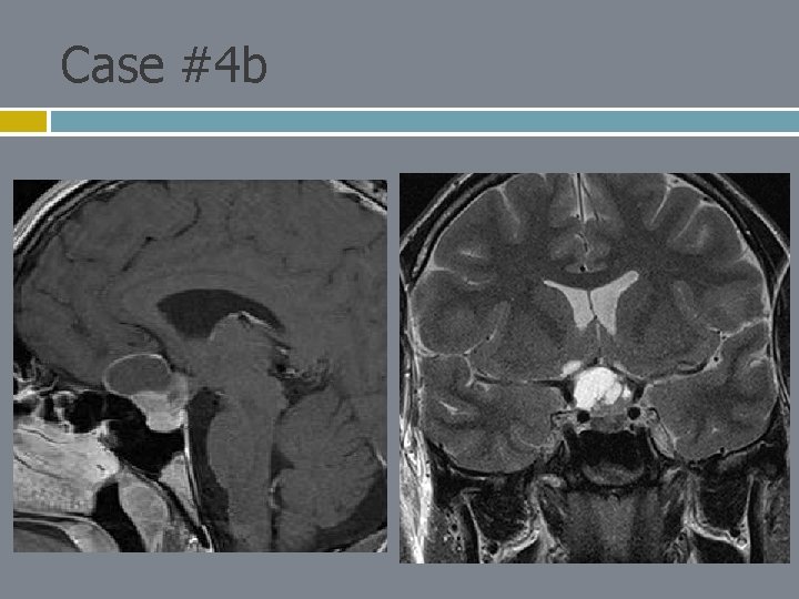 Case #4 b 