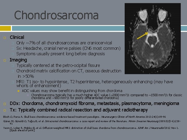 Chondrosarcoma Clinical � � � Only ~7% of all chondrosarcomas are craniocervical Sx: Headache,