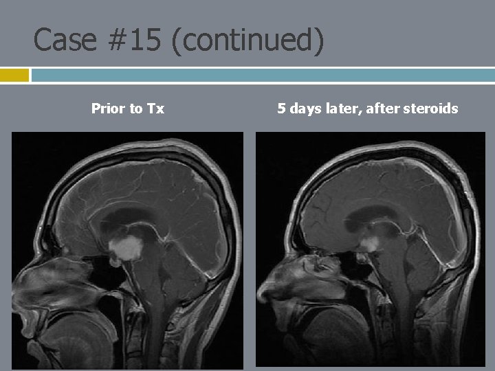 Case #15 (continued) Prior to Tx 5 days later, after steroids 