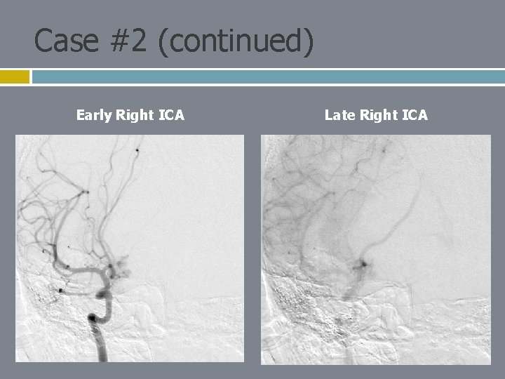 Case #2 (continued) Early Right ICA Late Right ICA 