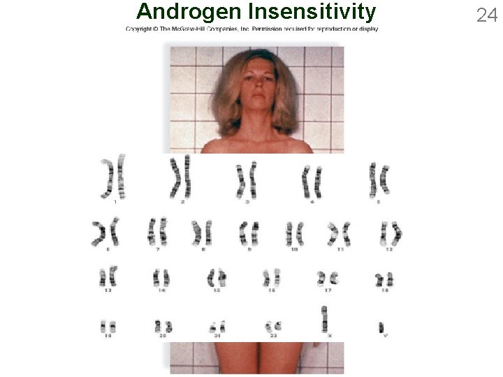 Androgen Insensitivity 24 