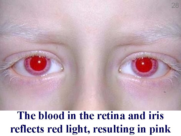 28 The blood in the retina and iris reflects red light, resulting in pink