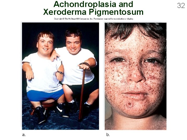 Achondroplasia and Xeroderma Pigmentosum 32 