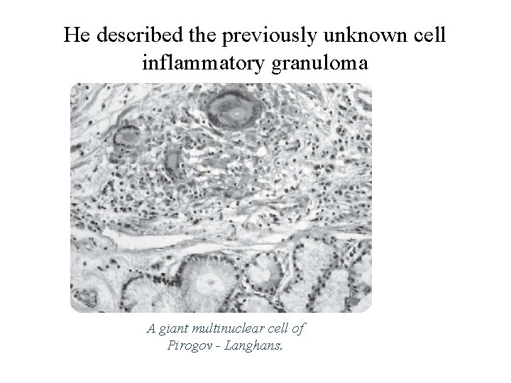 He described the previously unknown cell inflammatory granuloma A giant multinuclear cell of Pirogov He described the previously unknown cell inflammatory granuloma A giant multinuclear cell of Pirogov