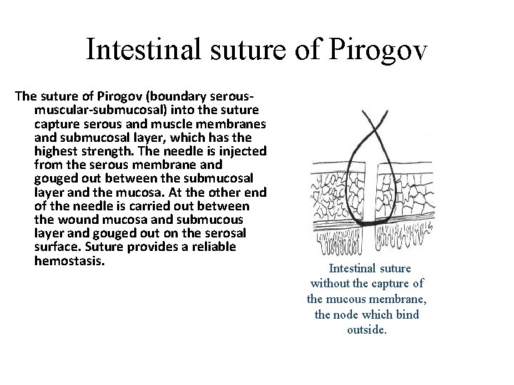 Intestinal suture of Pirogov The suture of Pirogov (boundary serousmuscular-submucosal) into the suture capture Intestinal suture of Pirogov The suture of Pirogov (boundary serousmuscular-submucosal) into the suture capture