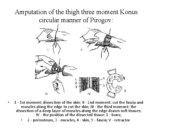 Amputation of the thigh three moment Konus circular manner of Pirogov: • 1 - Amputation of the thigh three moment Konus circular manner of Pirogov: • 1 -