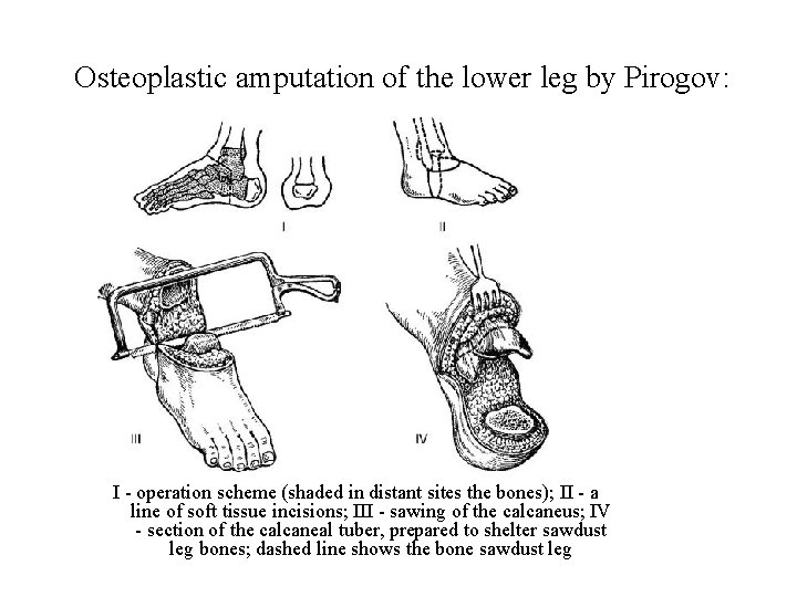 Osteoplastic amputation of the lower leg by Pirogov: I - operation scheme (shaded Osteoplastic amputation of the lower leg by Pirogov: I - operation scheme (shaded