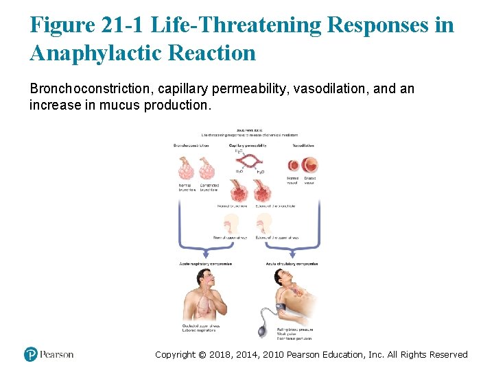 Figure 21 -1 Life-Threatening Responses in Anaphylactic Reaction Bronchoconstriction, capillary permeability, vasodilation, and an