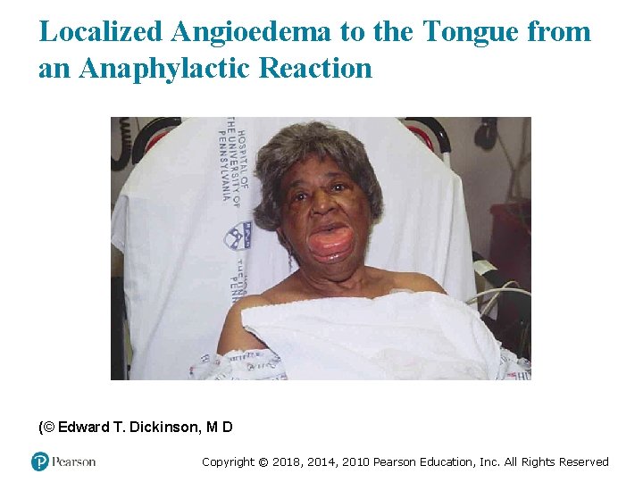 Localized Angioedema to the Tongue from an Anaphylactic Reaction (© Edward T. Dickinson, M