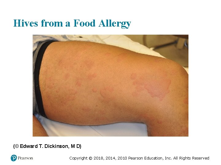 Hives from a Food Allergy (© Edward T. Dickinson, M D) Copyright © 2018,