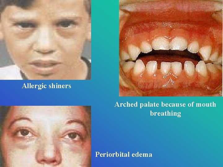 Allergic shiners Arched palate because of mouth breathing Periorbital edema 