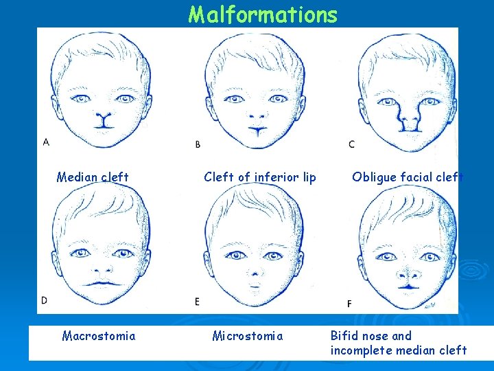 Malformations Median cleft Macrostomia Cleft of inferior lip Microstomia Obligue facial cleft Bifid nose