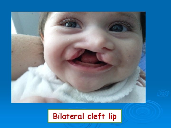 Bilateral cleft lip 