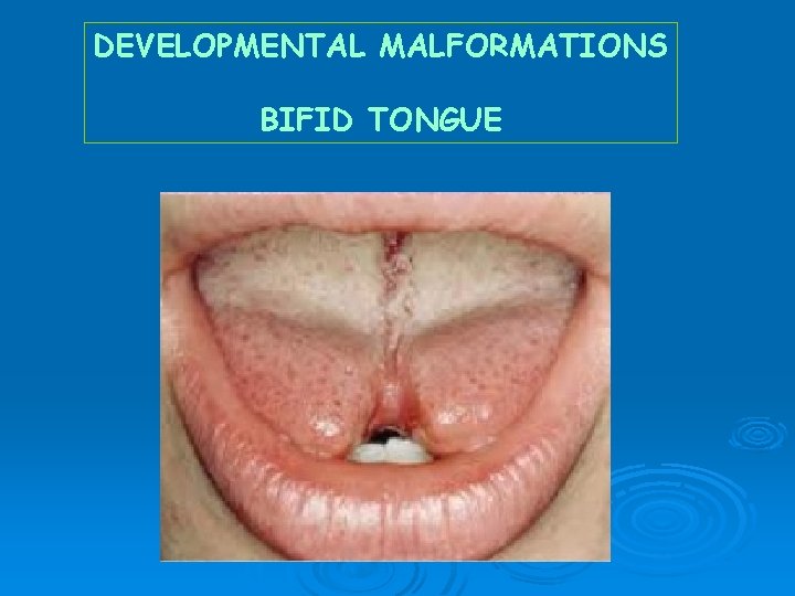 DEVELOPMENTAL MALFORMATIONS BIFID TONGUE 