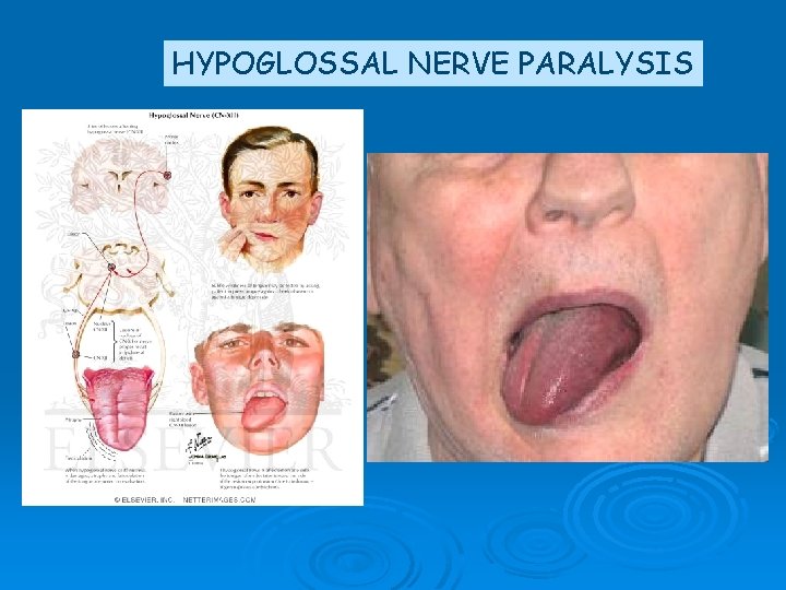 HYPOGLOSSAL NERVE PARALYSIS 