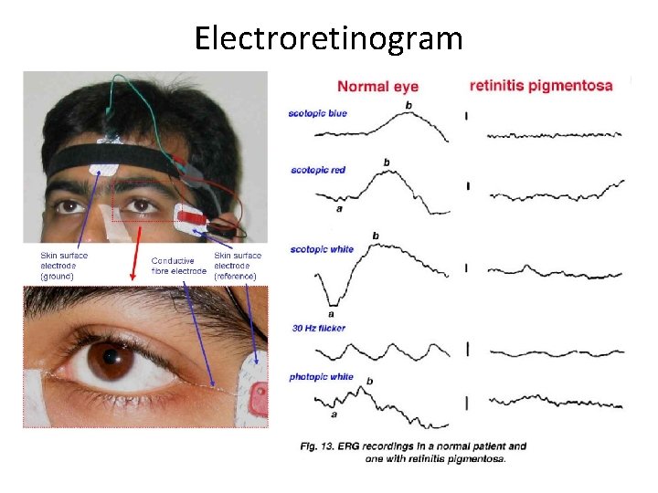 Electroretinogram 