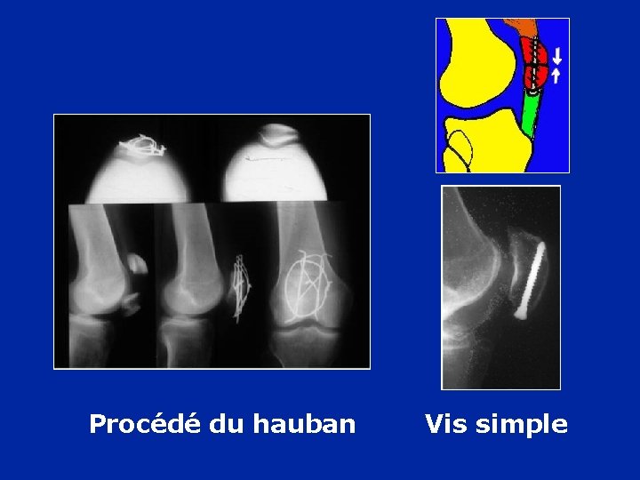 Procédé du hauban Vis simple 