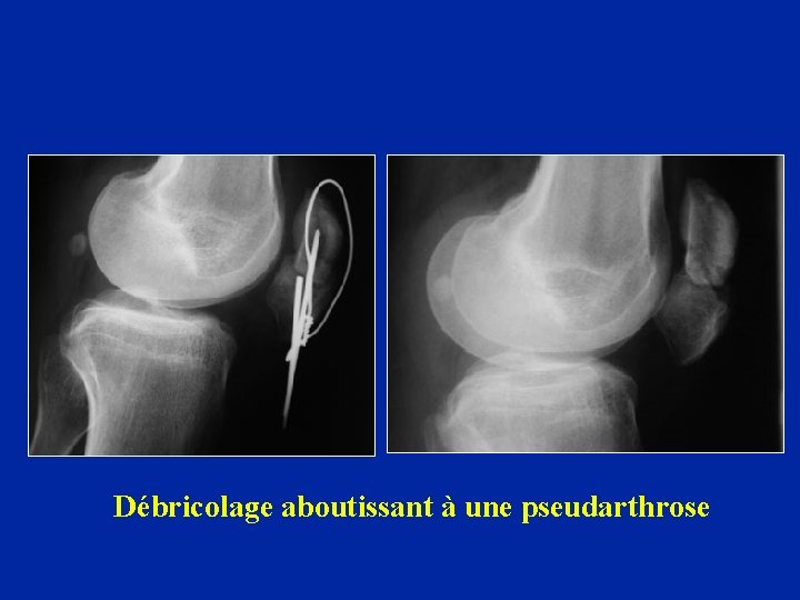 Débricolage aboutissant à une pseudarthrose 