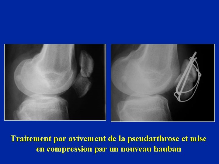 Traitement par avivement de la pseudarthrose et mise en compression par un nouveau hauban