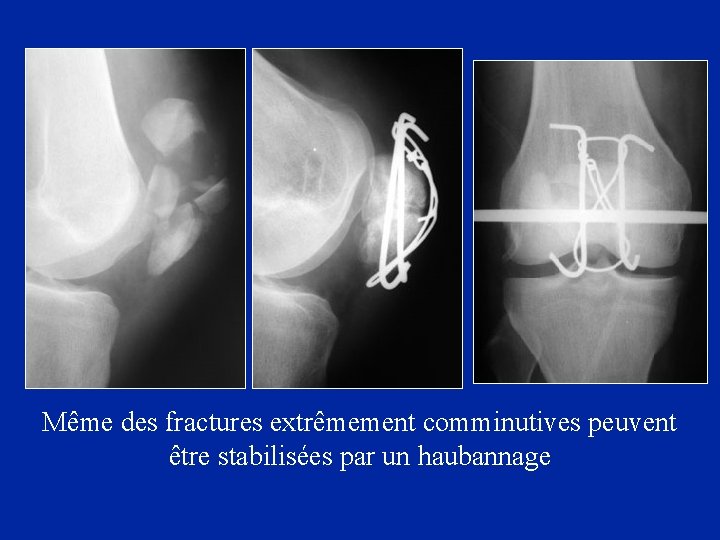 Même des fractures extrêmement comminutives peuvent être stabilisées par un haubannage 