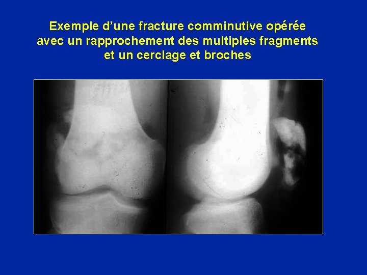 Exemple d’une fracture comminutive opérée avec un rapprochement des multiples fragments et un cerclage