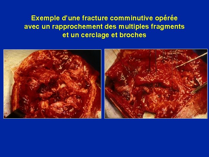 Exemple d’une fracture comminutive opérée avec un rapprochement des multiples fragments et un cerclage