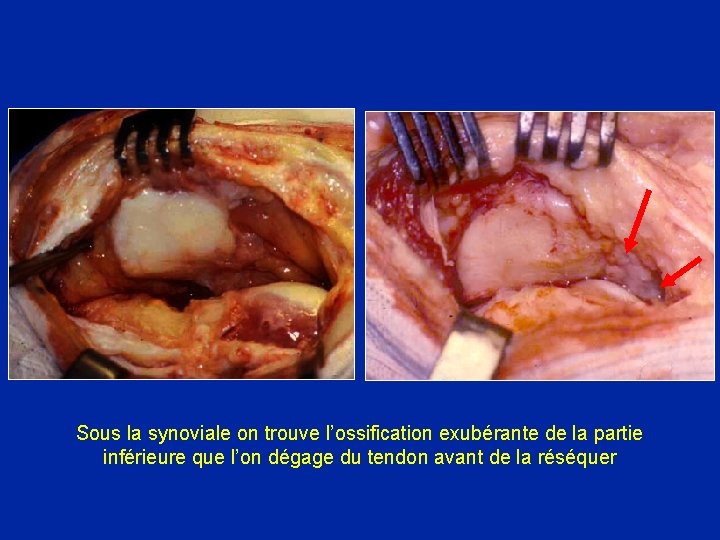 Sous la synoviale on trouve l’ossification exubérante de la partie inférieure que l’on dégage