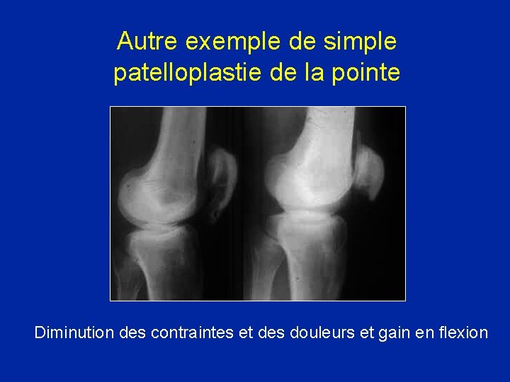 Autre exemple de simple patelloplastie de la pointe Diminution des contraintes et des douleurs