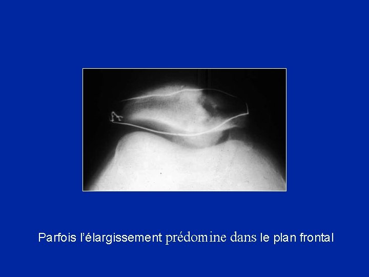 Parfois l’élargissement prédomine dans le plan frontal 