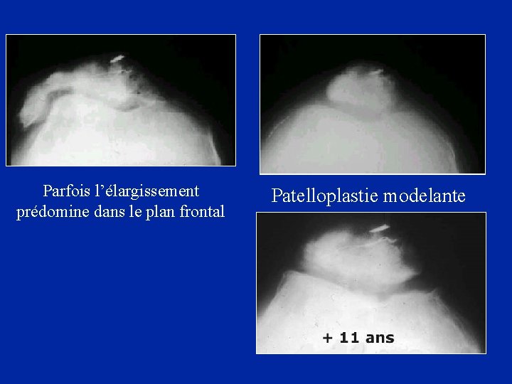 Parfois l’élargissement prédomine dans le plan frontal Patelloplastie modelante 