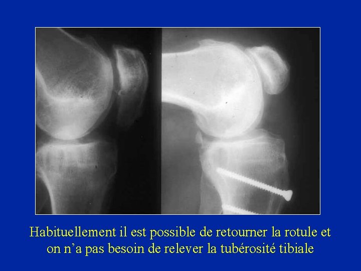 Habituellement il est possible de retourner la rotule et on n’a pas besoin de