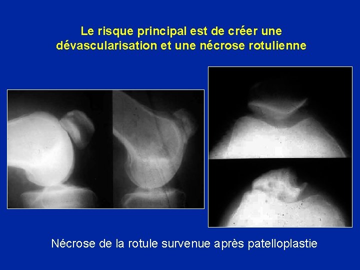 Le risque principal est de créer une dévascularisation et une nécrose rotulienne Nécrose de