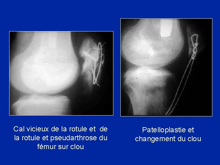 Cal vicieux de la rotule et pseudarthrose du fémur sur clou Patelloplastie et changement