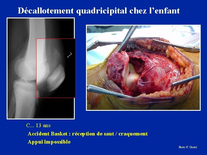 Décallotement quadricipital chez l’enfant C. . . 13 ans Accident Basket : réception de