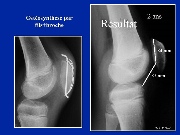 Ostéosynthèse par fils+broche Résultat 2 ans 34 mm 35 mm Photo F. Chotel 