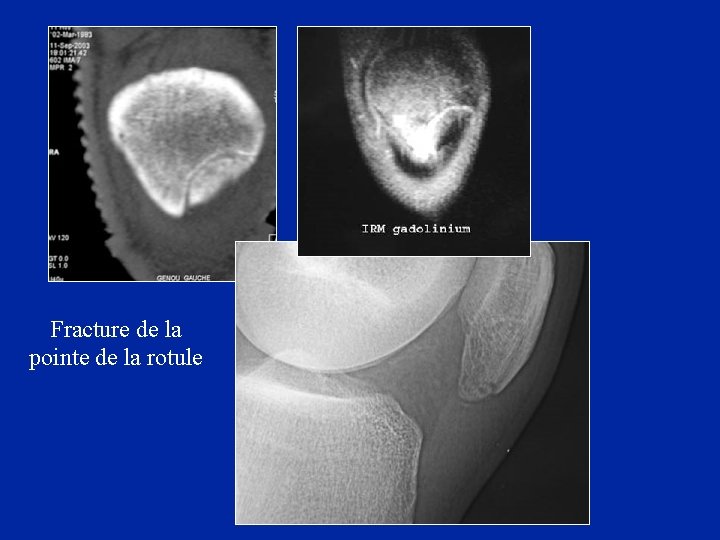 Fracture de la pointe de la rotule 