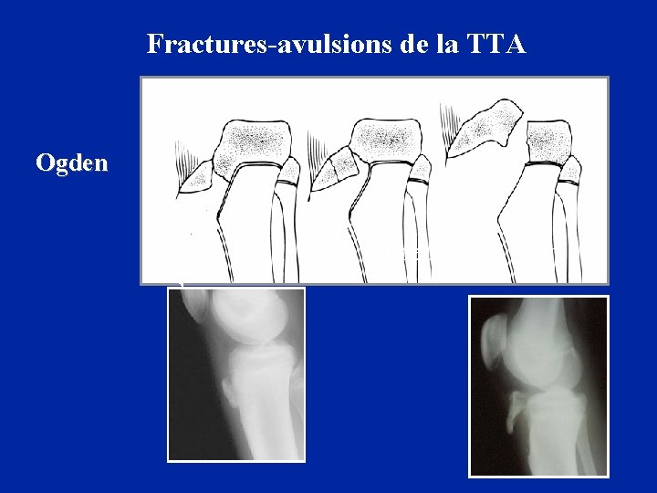 Fractures-avulsions de la TTA Ogden Type 1 3 Type 2 Type 