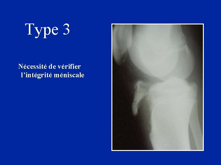 Type 3 Nécessité de vérifier l’intégrité méniscale 