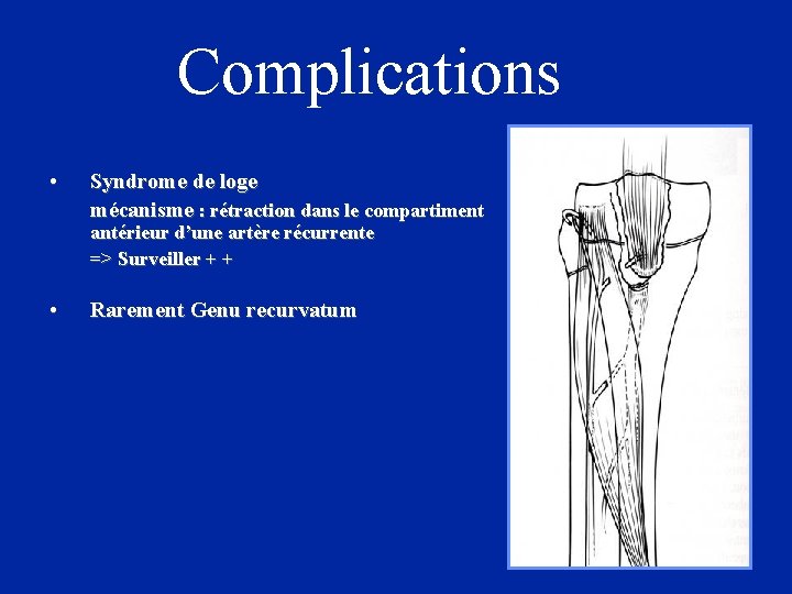 Complications • Syndrome de loge mécanisme : rétraction dans le compartiment antérieur d’une artère