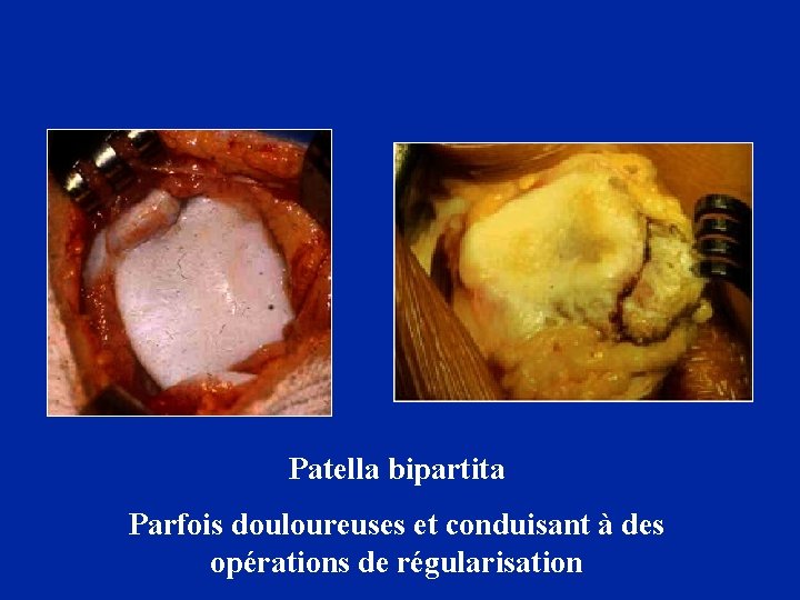 Patella bipartita Parfois douloureuses et conduisant à des opérations de régularisation 