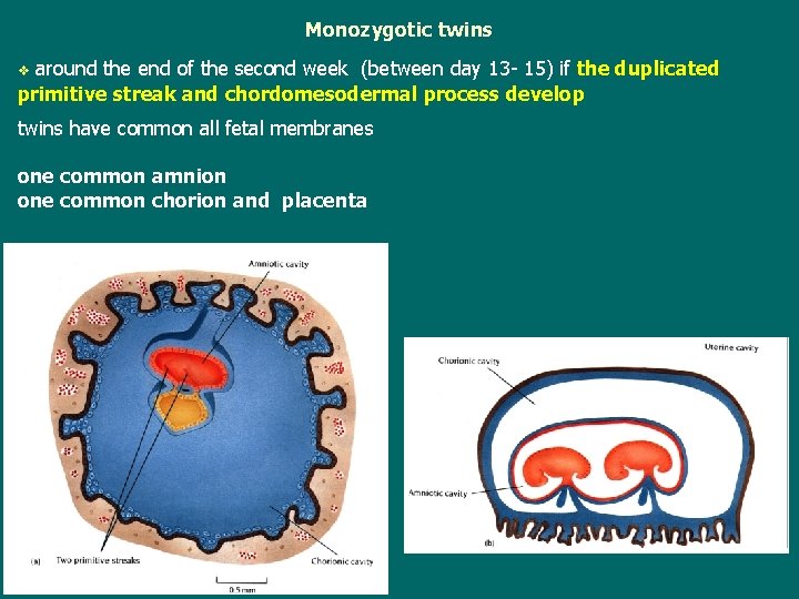 Monozygotic twins around the end of the second week (between day 13 - 15)