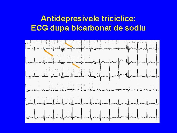 Antidepresivele triciclice: ECG dupa bicarbonat de sodiu 