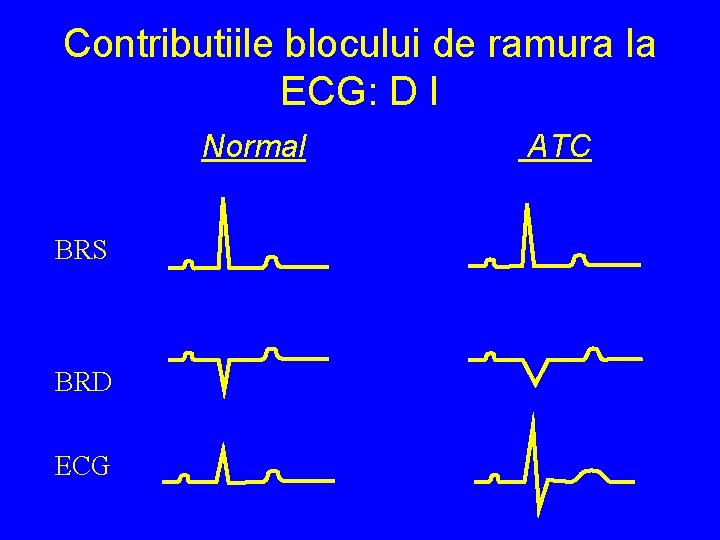 Contributiile blocului de ramura la ECG: D I Normal BRS BRD ECG ATC 