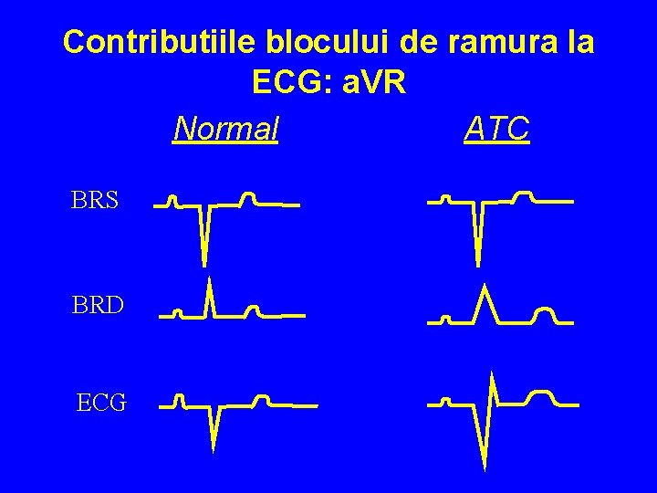 Contributiile blocului de ramura la ECG: a. VR Normal ATC BRS BRD ECG 