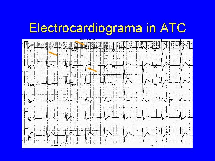 Electrocardiograma in ATC 