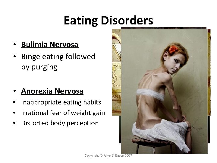 Eating Disorders • Bulimia Nervosa • Binge eating followed by purging • Anorexia Nervosa