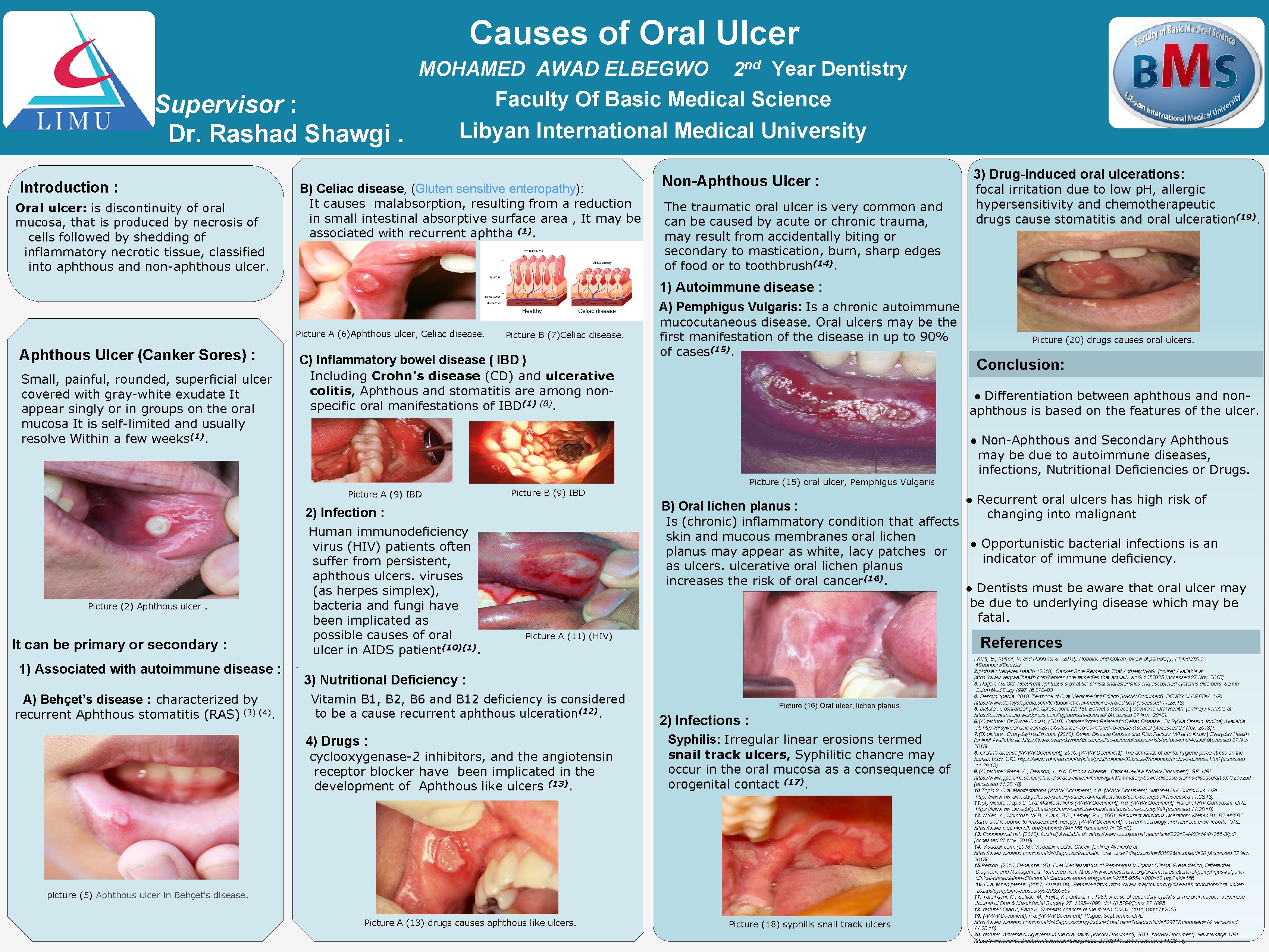 Causes of Oral Ulcer MOHAMED AWAD ELBEGWO Supervisor : Dr. Rashad Shawgi. Introduction :